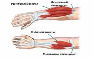 Бурсит локтевого сустава