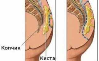 Как проявляется остеохондроз копчика? методы лечения заболевания