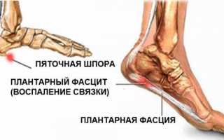 Лечение подошвенного фасциита народными средствами в домашних условиях