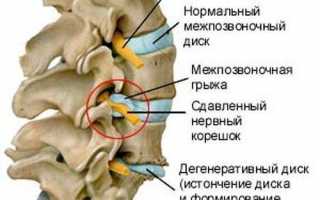 Синдром цервикобрахиалгии