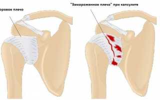 Почему болит рука от локтя до плеча?