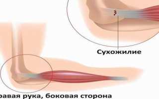 Растяжение связок локтевого сустава: что делать и как лечить