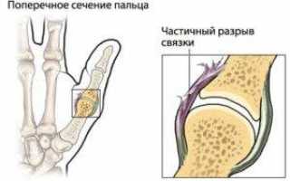 Растяжение связок руки: лечение и реабилитация