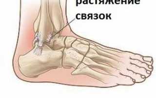 Растяжение сухожилий, связок и мышц