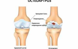 Что может болеть ниже поясницы справа от позвоночника
